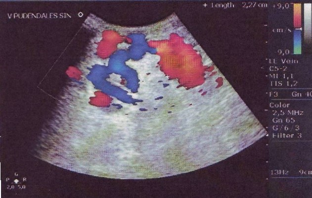 pe ultrasunete a aratat varicoza ce lenjerie de corp sa poarte cu varicoza