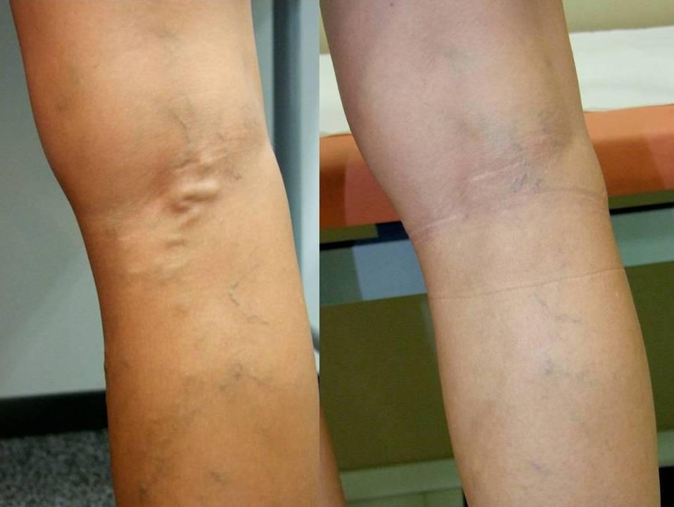 Bolovi u nogama iznad koljena: Uzrok, simptomi i kako ju točno liječiti?